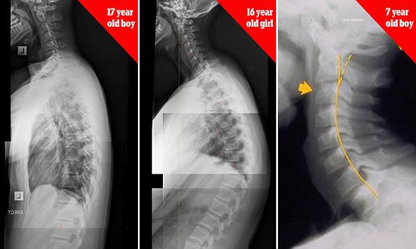 radiografia de uma corcova de sms