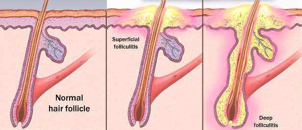 foliculite inflamacao