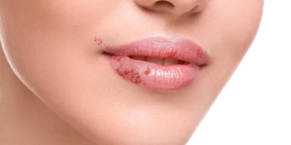 herpes-labial