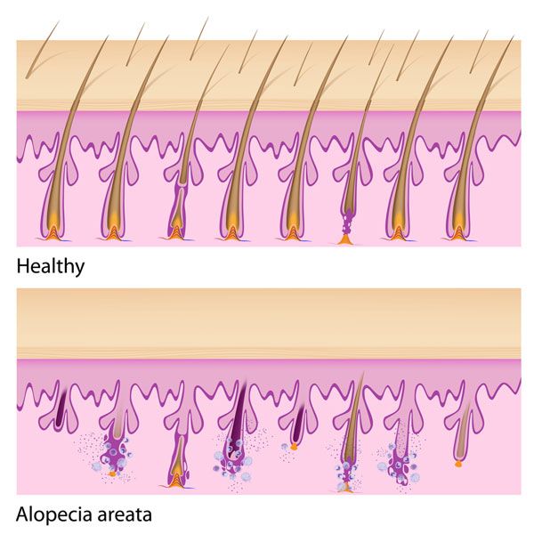 alopecia 2