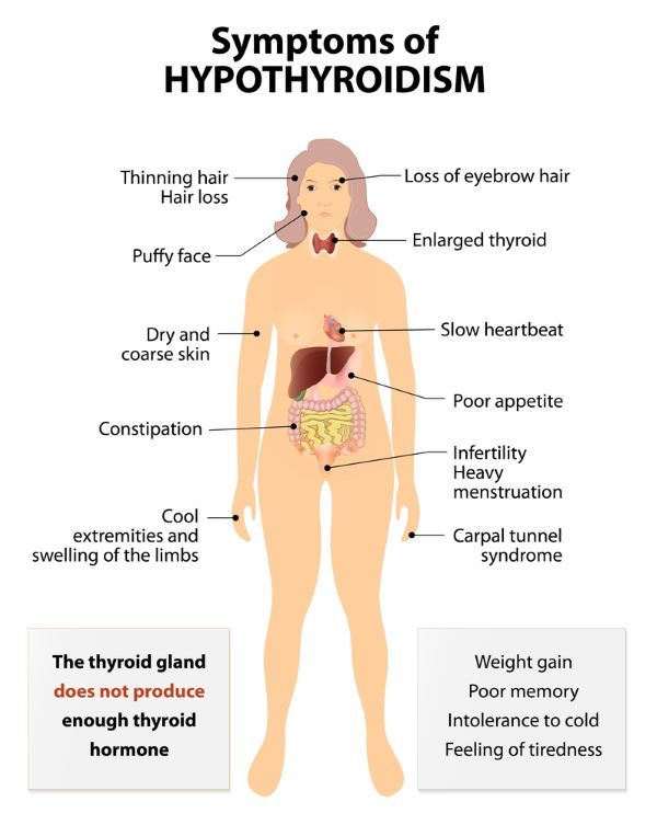 síntomas de hipotiroidismo