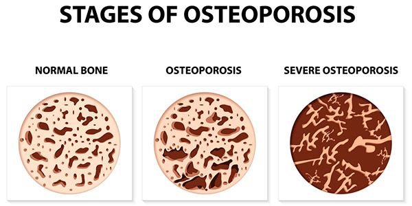 osteoporosis estagios