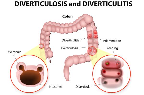 dieta para diverticulite