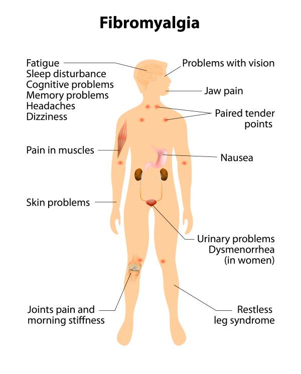 fibromialgia sintomas 2