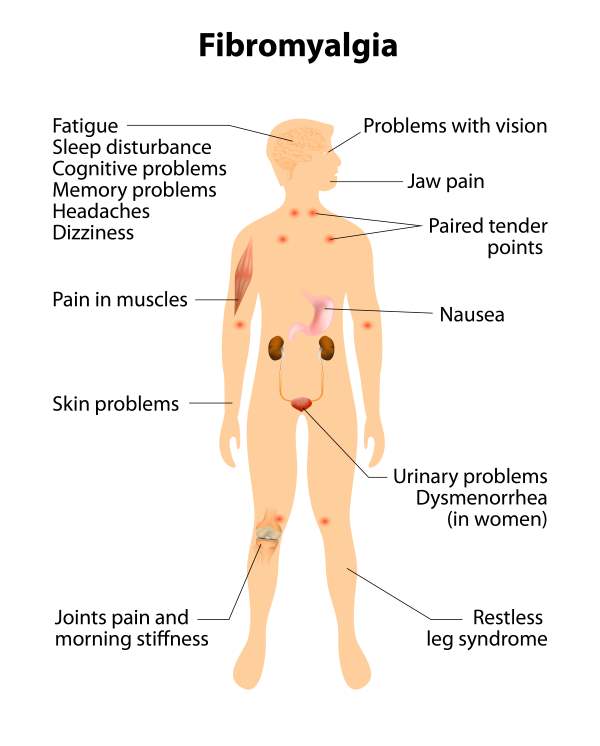 fibromialgia sintomas 2
