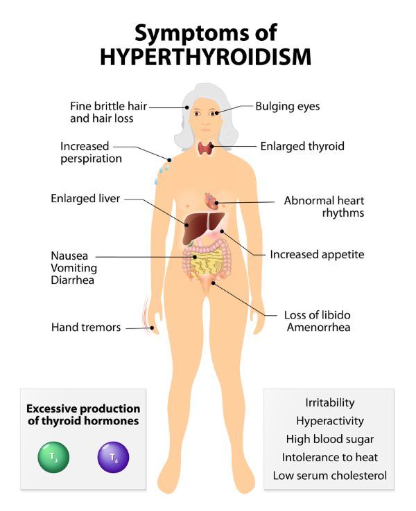 hipertireoidismo