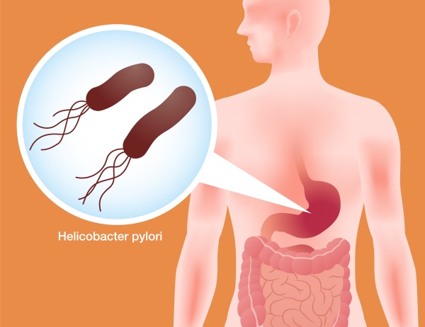 helicobacter pylori