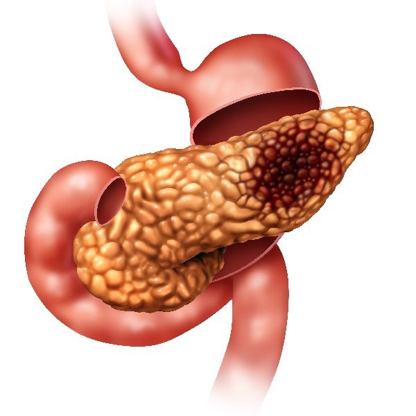 tumor pancreas 2