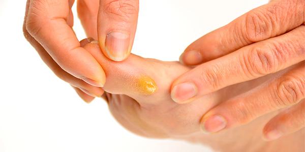 Calos: 10 REMÉDIOS NATURAIS Para Acabar com Eles - GreenMe.com.br