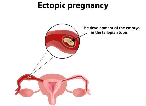 gravidez ectópica 2