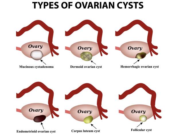 tipos de cistos