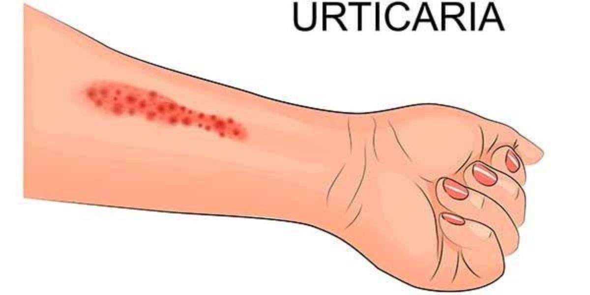 Tratamento de veias a laser san antonio texas