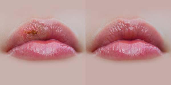 herpes labial