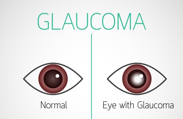 glaucoma 2