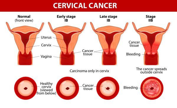 cancer cervical