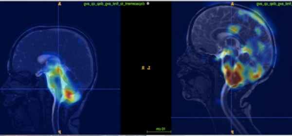 coracao cerebro 2