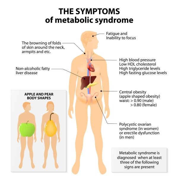 sindrome metabolica