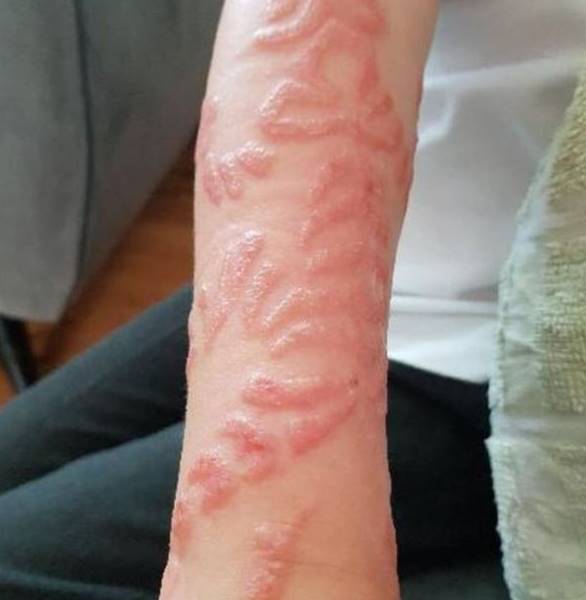 tatuagem alergia