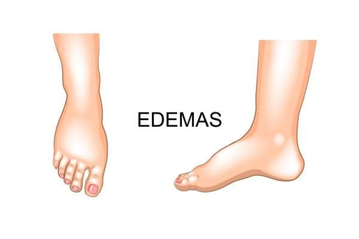 Edema medicação anti