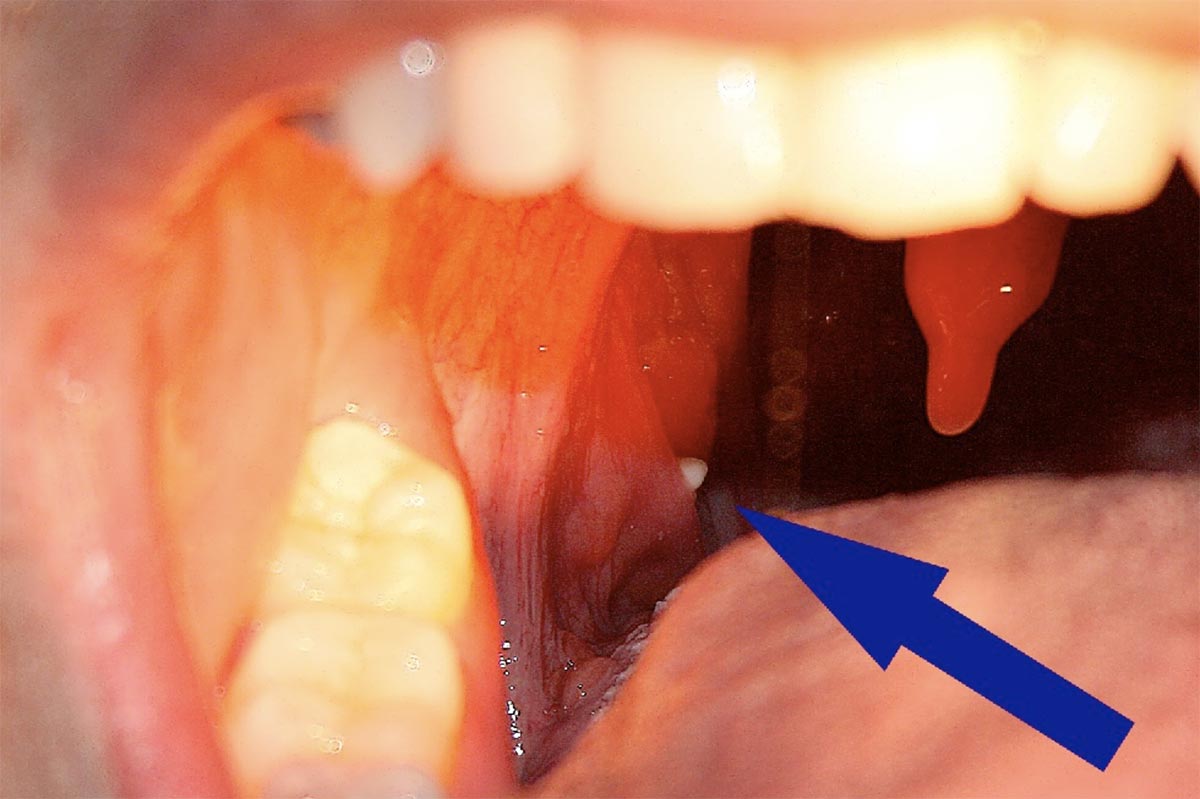 Caseum: bolinha branca na garganta. Causas, prevenção e como