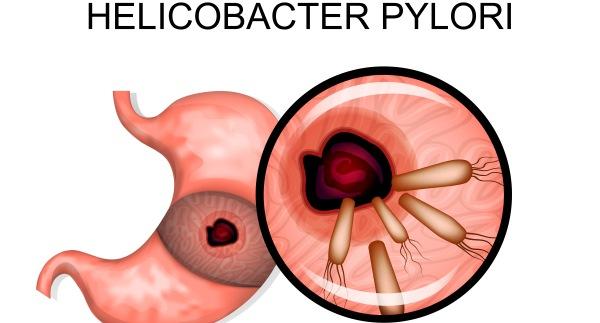 Infecția cu Helicobacter Pylori - cauze și manifestări