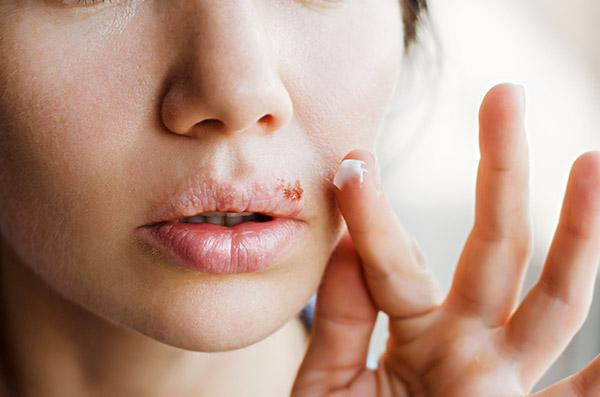 Herpes labial: o que é, quais são os sintomas e como evitar - greenMe