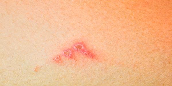 Impetigo Em Bebes Causas Transmissao E Tratamentos Caseiros Greenme Impetigo Em Bebes Causas Transmissao E Tratamentos Caseiros Greenme
