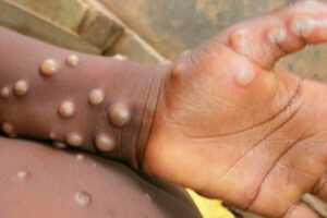 © WHO/Nigeria Center For Disease Control